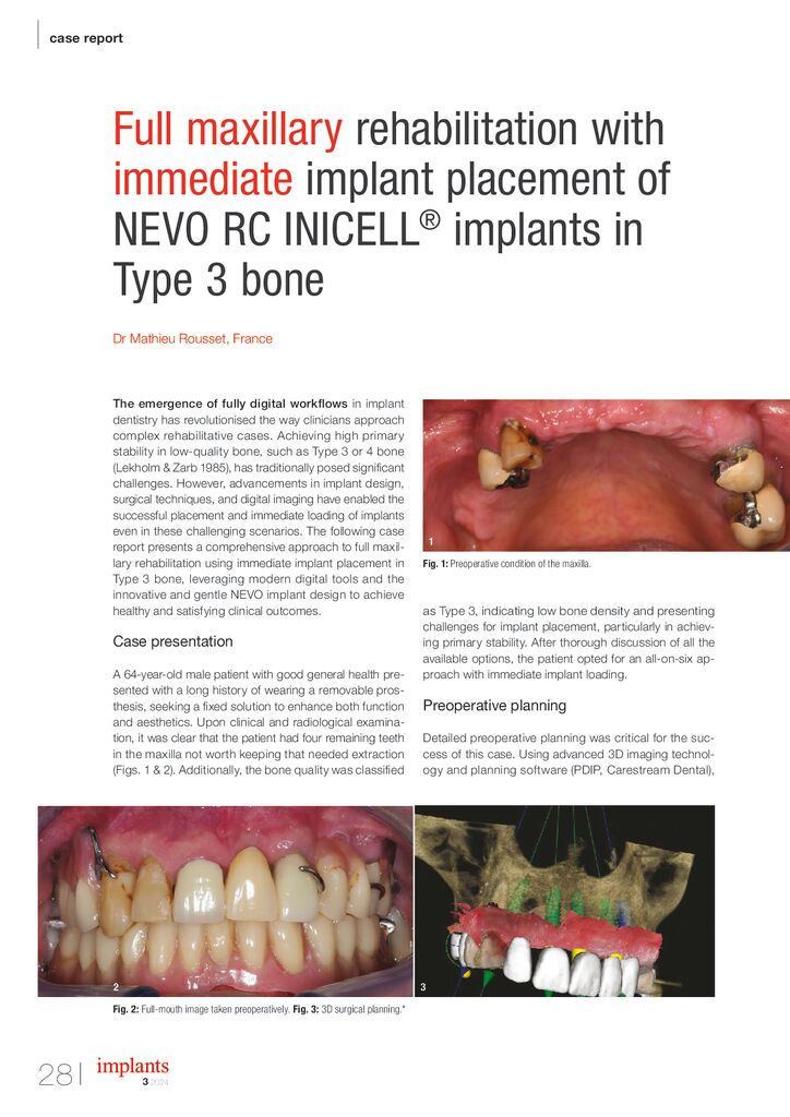 thumbnail of Full maxillary rehabilitation with immediate implant placement